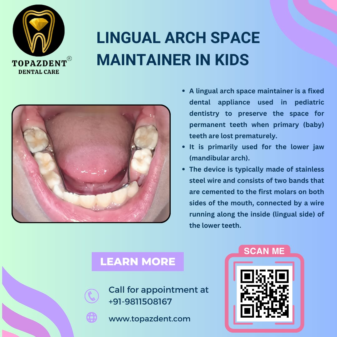 Lingual Arch Space Maintainer in Kids: A Comprehensive Guide